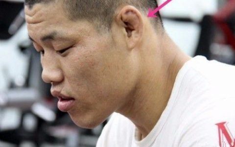 ufc的耳朵为什么那么厚（为什么很多UFC选手的耳朵长的像个饺子？真相让人很心酸！）